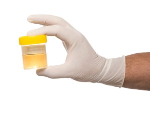 Urine Sample